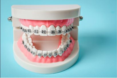 Apparecchi tradizionali, in ceramica e linguali albania dental aesthetics