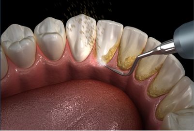 Pulizia dei denti albania dental aesthetic