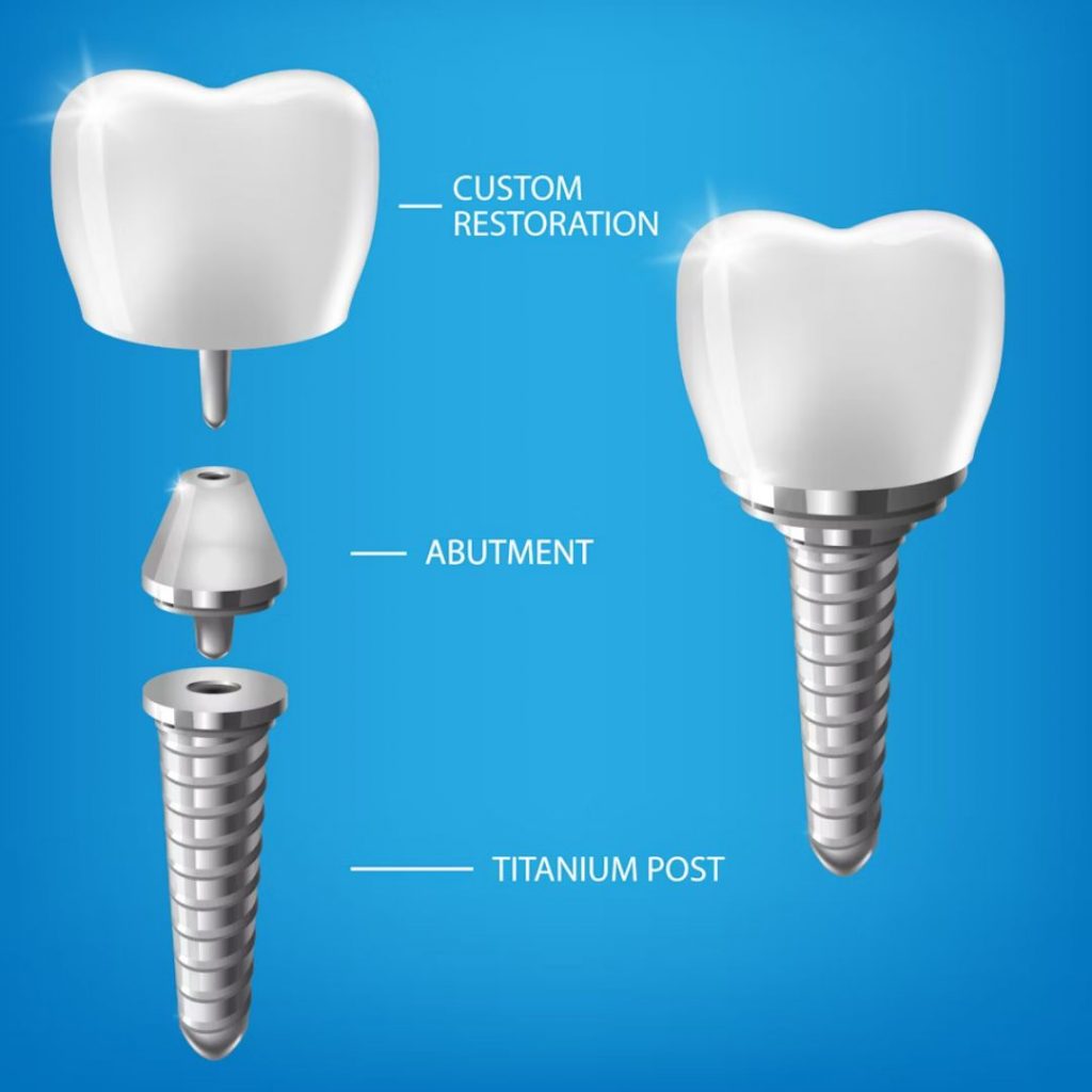 Diagram showing the implant, abutment, and crown components.