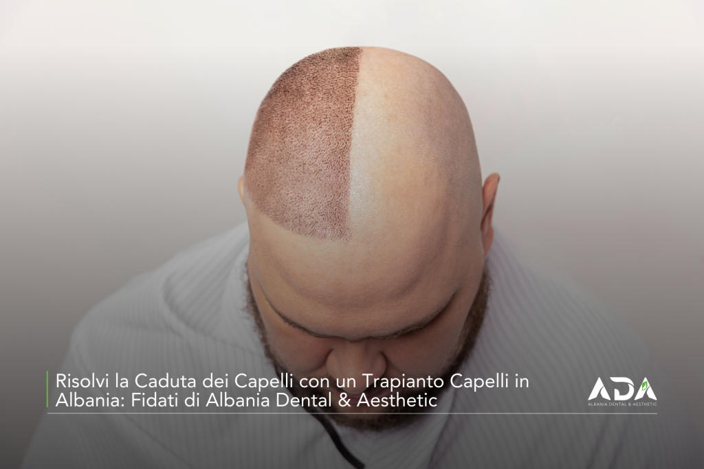 Risolvi la Caduta dei Capelli con un Trapianto Capelli in Albania Fidati di Albania Dental & Aesthetic