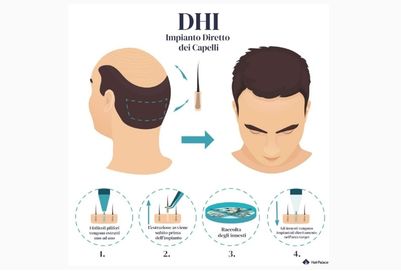 Tecnica DHI (Impianto Diretto di Capelli) Albania Dental & Aesthetics